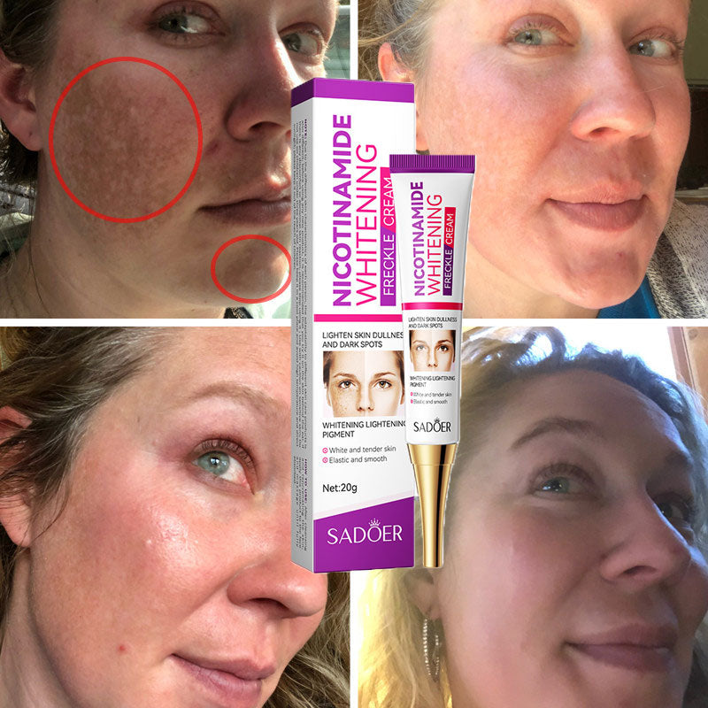 Nicotinamide Whitening Freckles Cream Remove Melasma Dark Spot Acne Marks Lightening Melanin