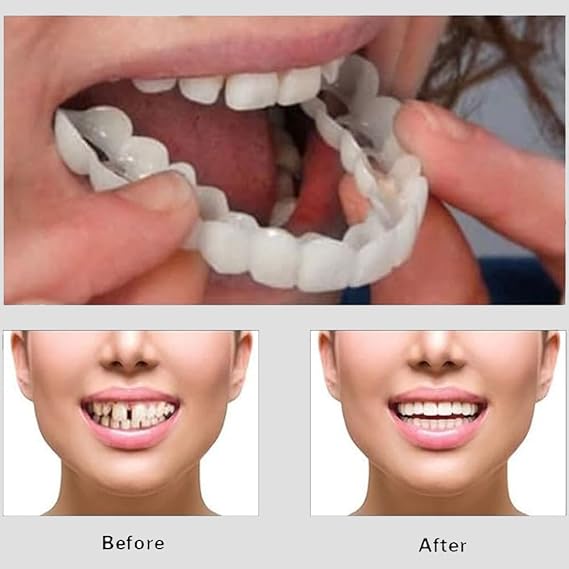Snap On Smile - Veneers Teeth for Men and Women - Moldable