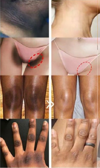 Whitening Cream for sensitive Areas underarm and private Areas - 30g