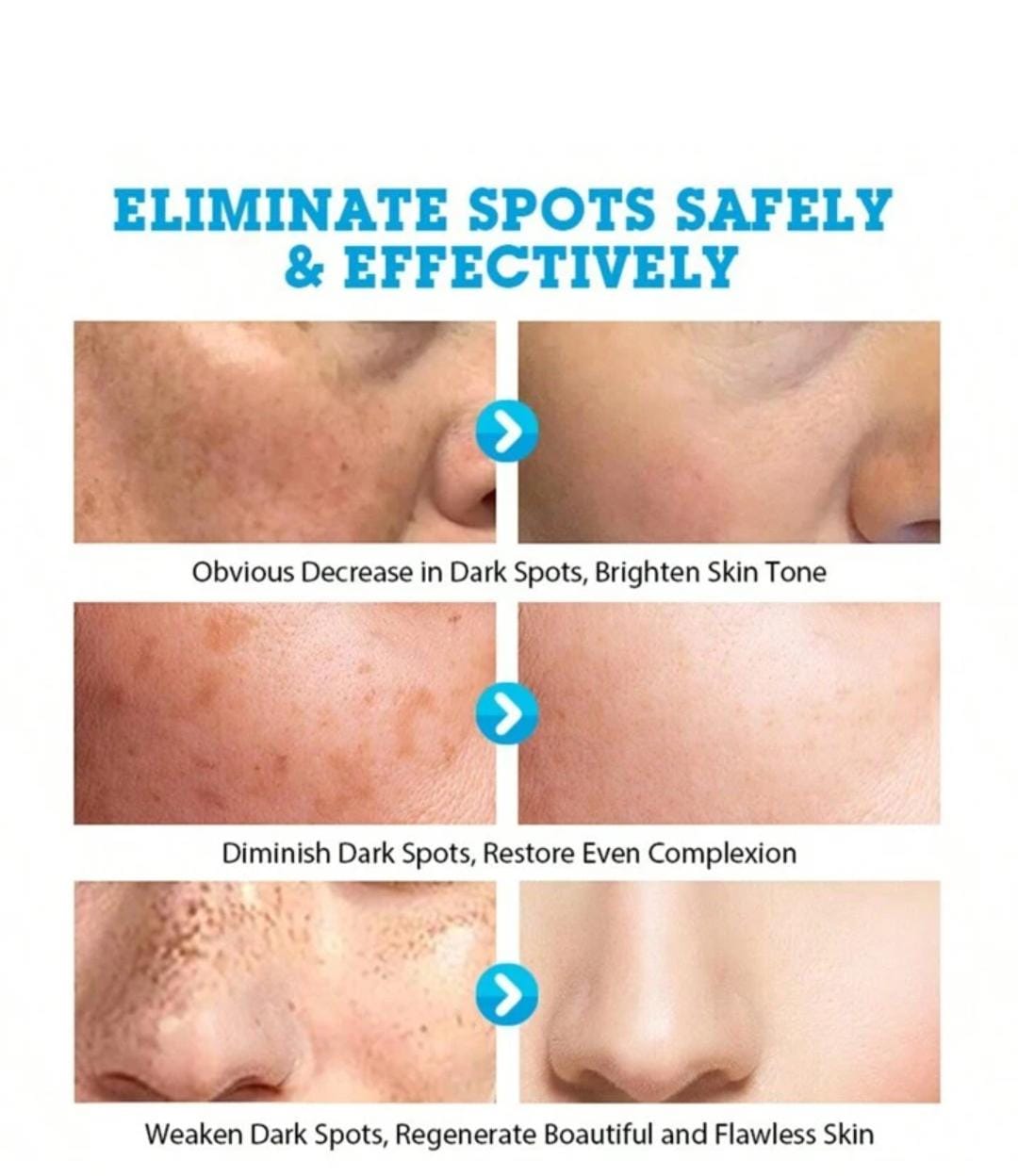 MESTIN Anti-Sun Spot Essence 30ml - Corrects Hyperpigmentation, Fades Dark Spots, Evens