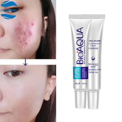 BIOAQUA Anti Acne Cream Acne Scar Removal Cream | Best Quality Scar